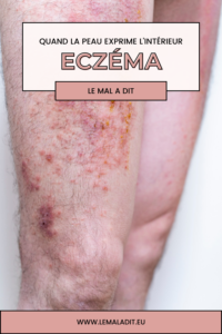 eczéma